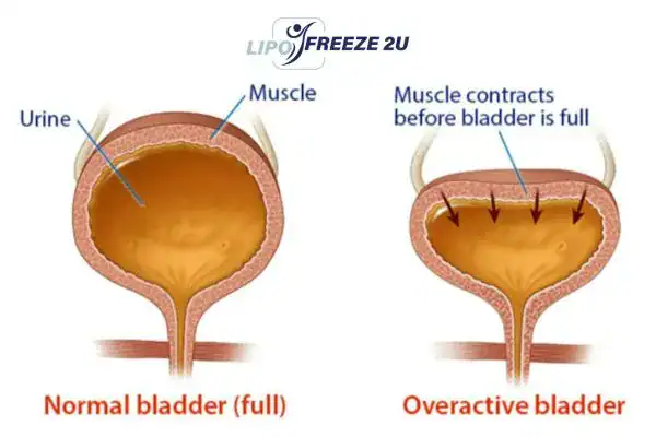 diagram of overactive bladder treatment Matlock