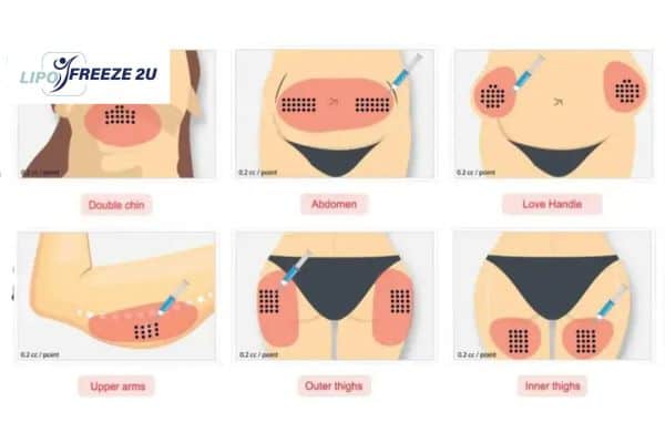 Benefits of Choosing Aqualyx for Fat Reduction Matlock