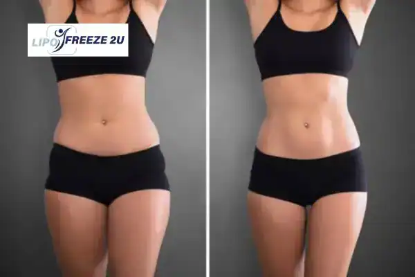 How Can LIPO FREEZE 2U Support Your Post-Pregnancy Body Recovery Matlock?