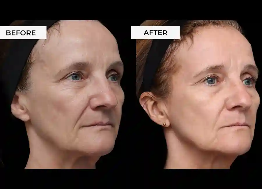 How Many RF Microneedling Sessions Will You Need to See a Difference Matlock?
