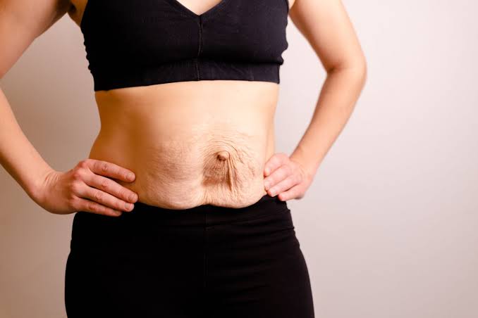 Is Surgery Really the Only Way to Repair Diastasis Recti Matlock?