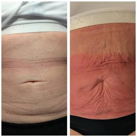How Does RF Microneedling Improve Crepey, Thin and Uneven Skin Texture Matlock?