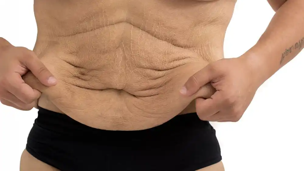 RF Microneedling for Loose Skin: How Can It Help Tighten and Reshape the Skin Matlock?